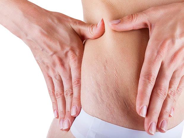 Nguyên nhân chính dẫn đến tình trạng rạn da