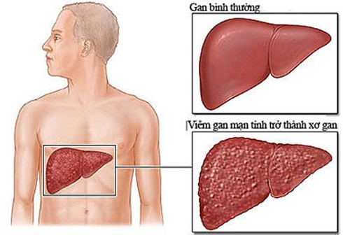 Nấm linh chi Hàn Quốc có tác dụng gì trong điều trị bệnh viêm gan mãn tính?