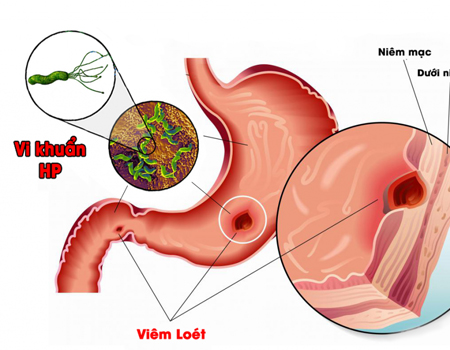 Vi Khuẩn HP Gây Loét Dạ Dày Và Cách Điều Trị